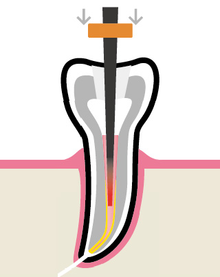 Вертикальная конденсация - этап 1 удаления излишков